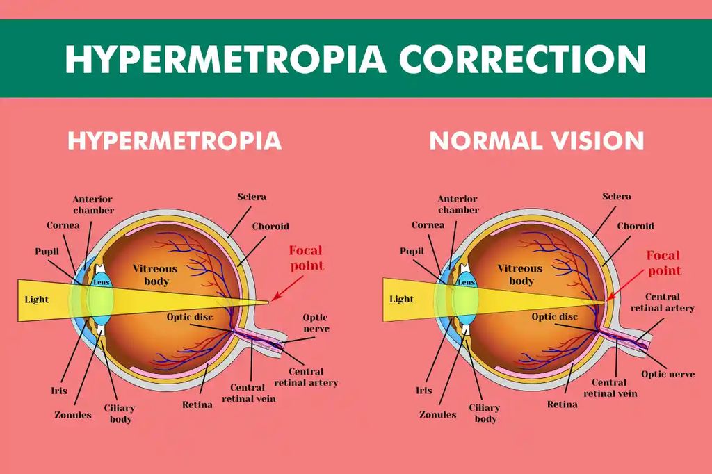 hypermetropia vs. normál látás infografika