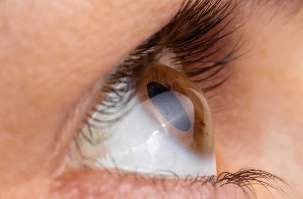 Keratoconus