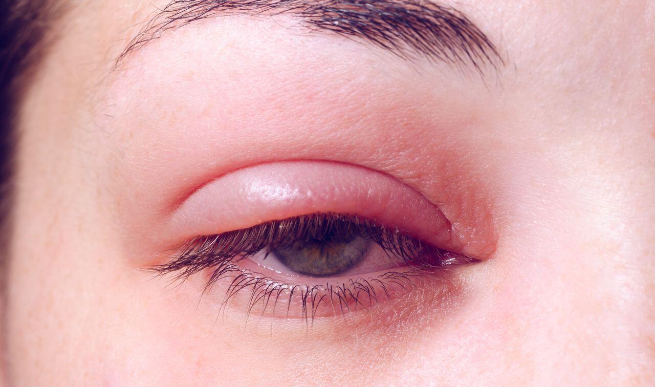 Vörös, irritált szemhéj, a szemhéjszéli gyulladás (blepharitis) egyik jellegzetes tünete.