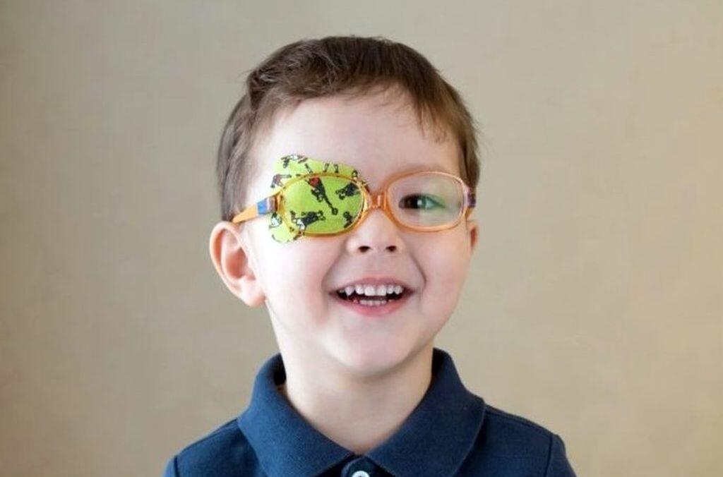 Tompalátás miatt fiatal gyermek szemtakarós szemüvegben